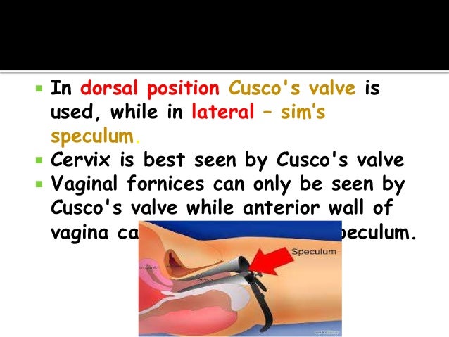 palpating the vaginal wall Palpating the vaginal wall